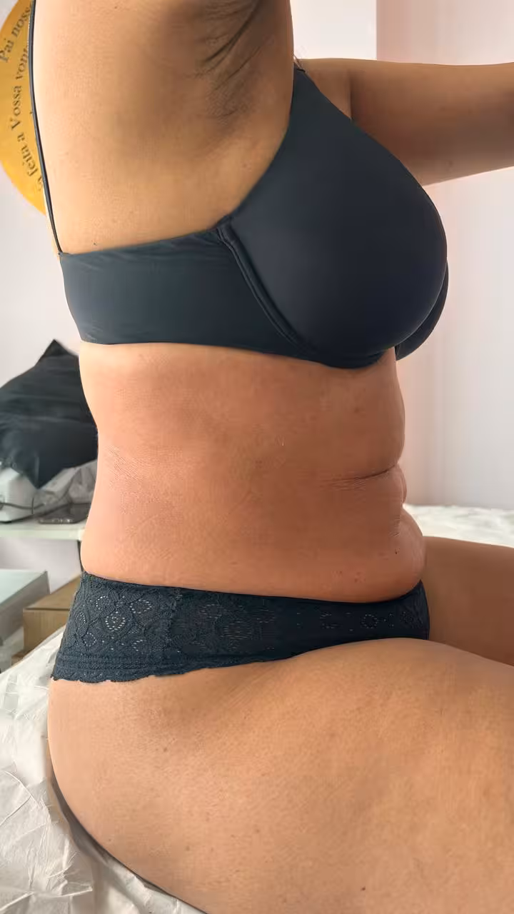 Depois - Diástase abdominal